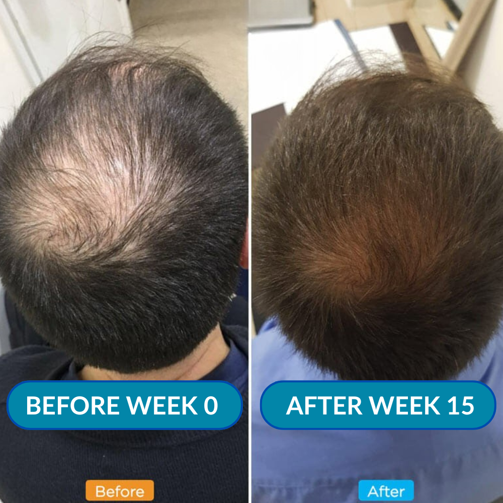 ONEFIX™ Advanced Micro - Infusion Hair Regrowth Kit