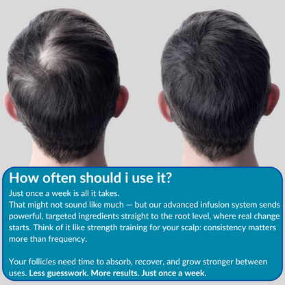 ONEFIX™ - Advanced Micro-Infusion Hair Regrowth Kit
