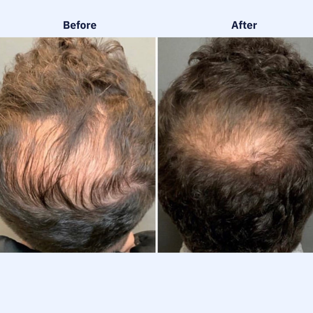 ONEFIX™ Growth Protocol 100% Natural Hair Oil