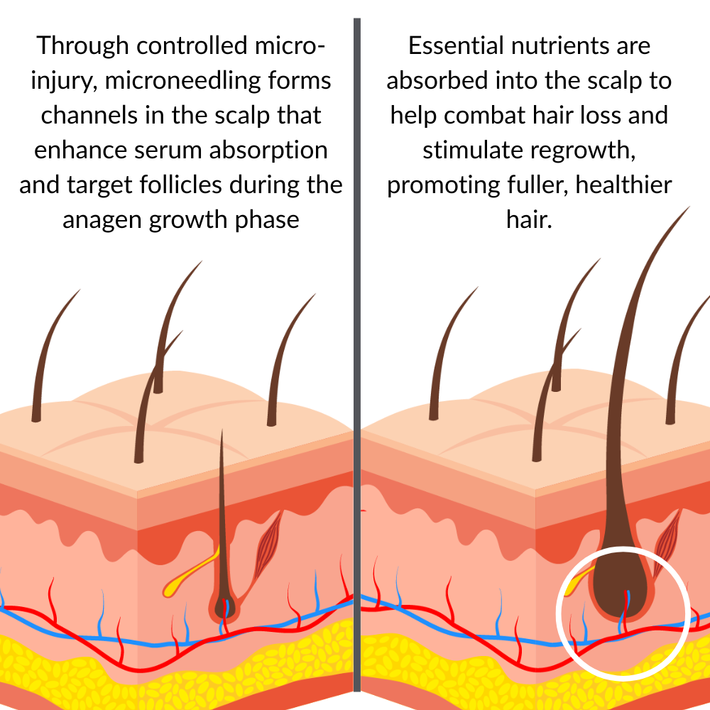 ONEFIX™ - Advanced Micro-Infusion Hair Regrowth Kit